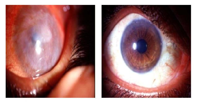 BL02_CORNEA_1101547f